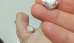 去除鸡眼视频,跟随视频教程学除法